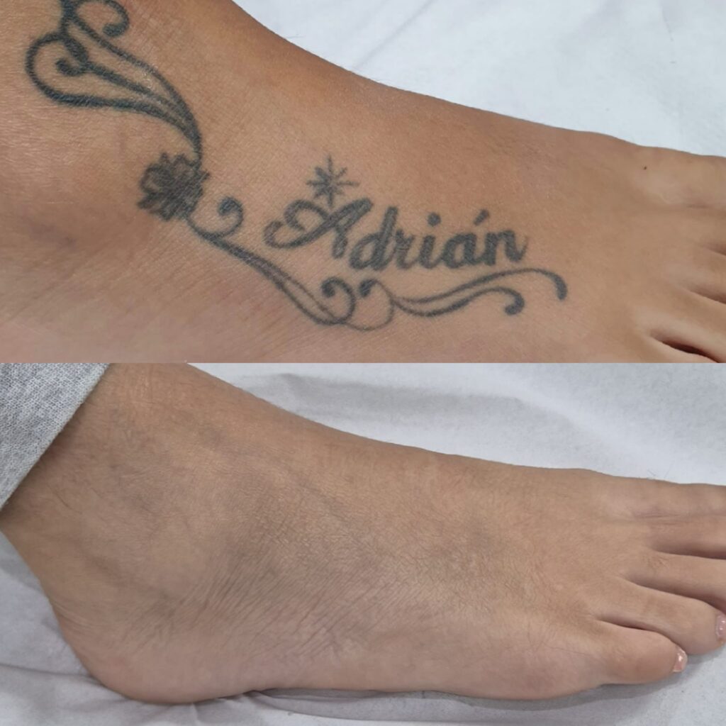Resultado de eliminaci&oacute;n de tatuajes con l&aacute;ser en Altea