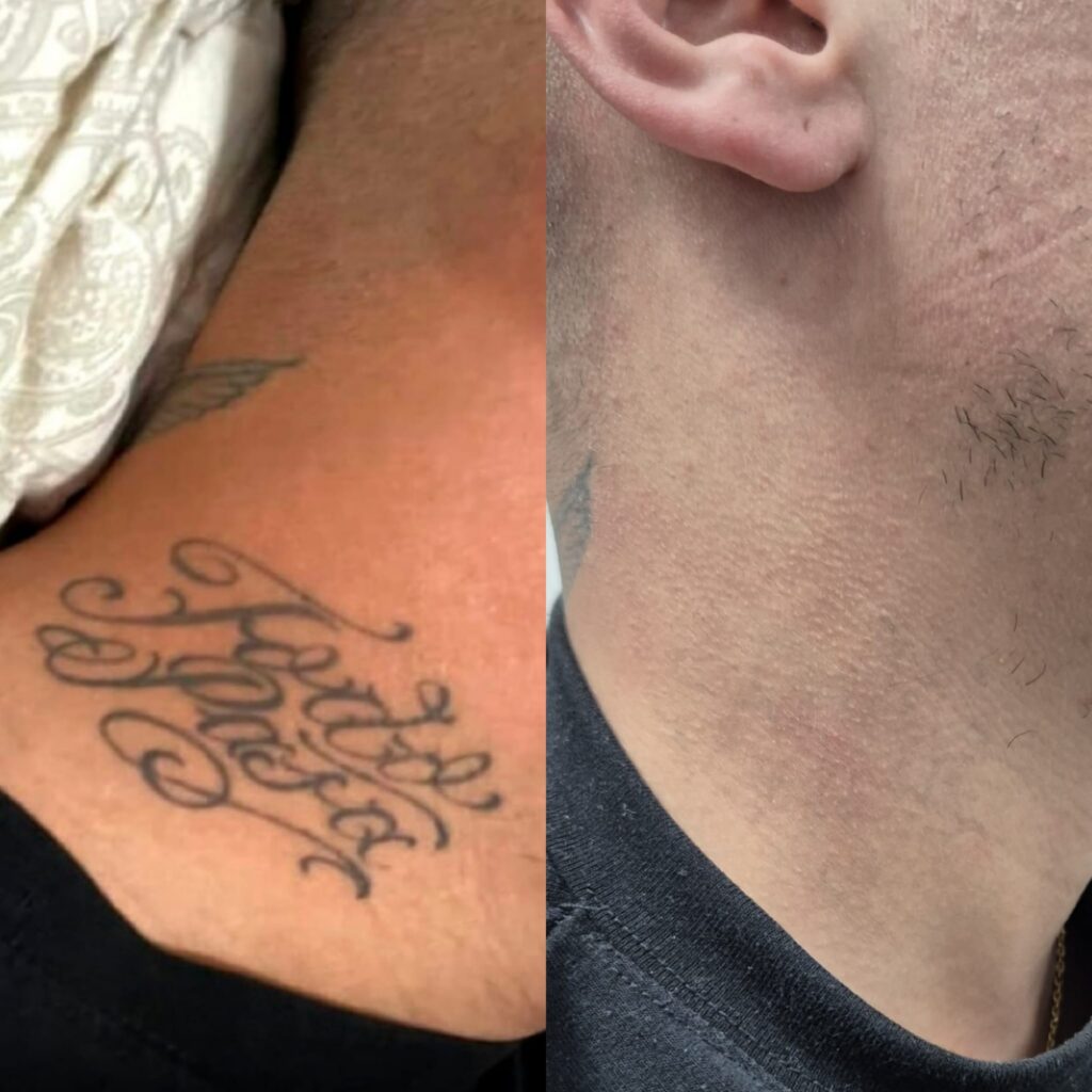 Resultado de eliminaci&oacute;n de tatuajes con l&aacute;ser en Altea