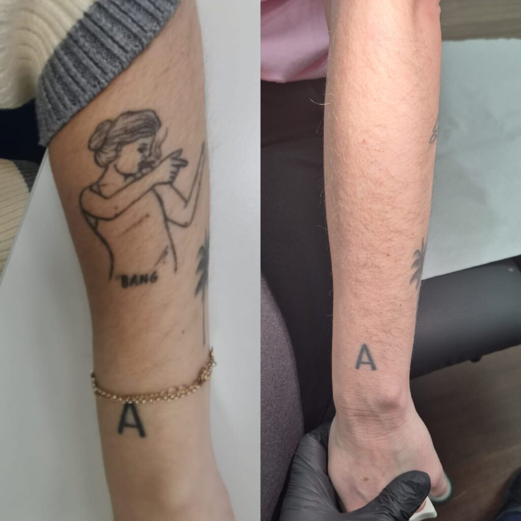 Resultado de eliminaci&oacute;n de tatuajes con l&aacute;ser en Altea