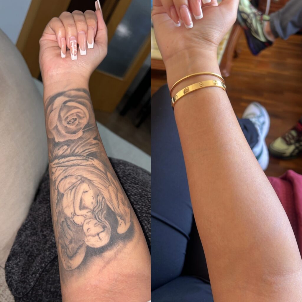 Resultado de eliminaci&oacute;n de tatuajes con l&aacute;ser en Altea